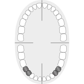 KKD_Zahnschema_Praemolaren_2+2T+W2